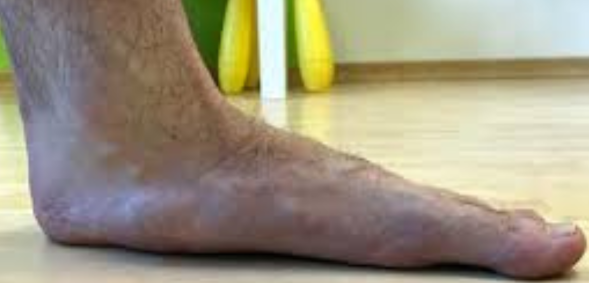 Do Insoles Work for Flat Feet?