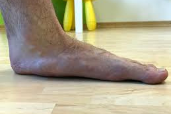 Do Insoles work for flat feet?